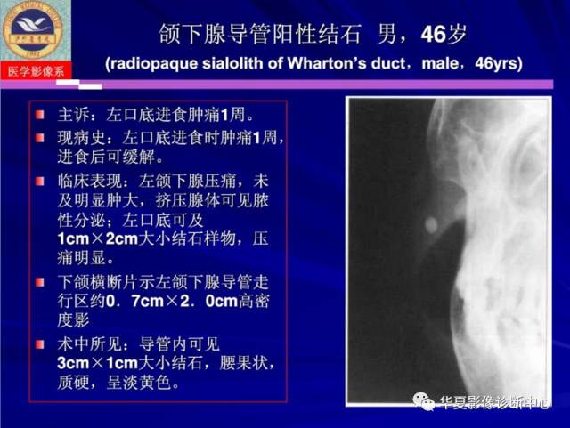 【PPT】涎腺疾病与颞下颌关节疾病影像诊断
