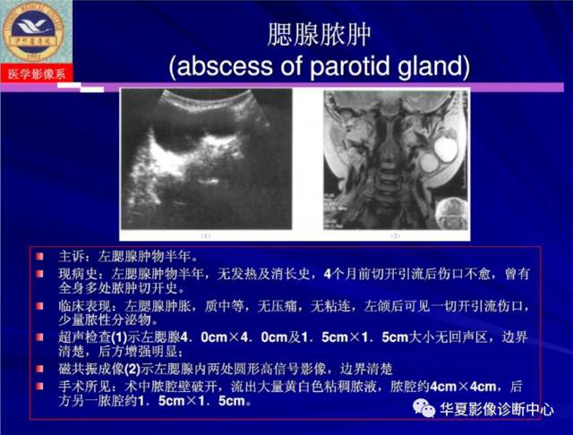 【PPT】涎腺疾病与颞下颌关节疾病影像诊断