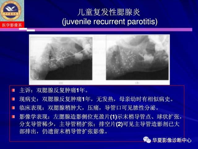 【PPT】涎腺疾病与颞下颌关节疾病影像诊断