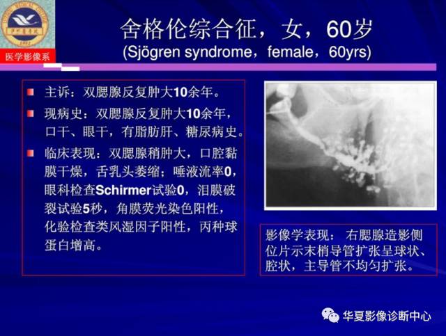 【PPT】涎腺疾病与颞下颌关节疾病影像诊断