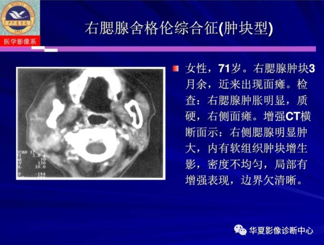 【PPT】涎腺疾病与颞下颌关节疾病影像诊断