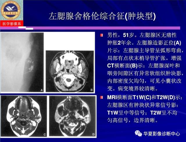 【PPT】涎腺疾病与颞下颌关节疾病影像诊断