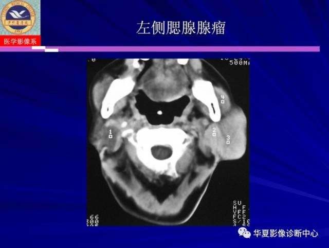 【PPT】涎腺疾病与颞下颌关节疾病影像诊断