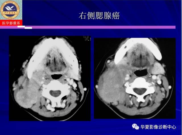 【PPT】涎腺疾病与颞下颌关节疾病影像诊断