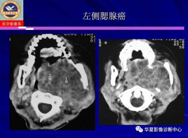 【PPT】涎腺疾病与颞下颌关节疾病影像诊断