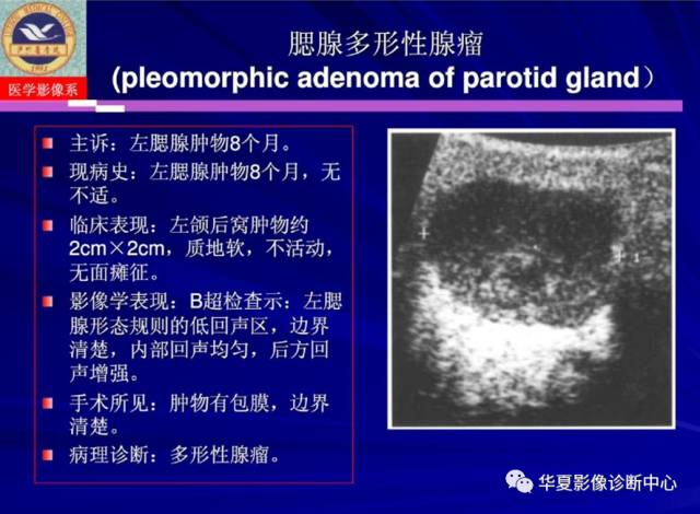 【PPT】涎腺疾病与颞下颌关节疾病影像诊断