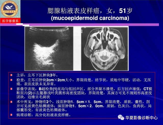 【PPT】涎腺疾病与颞下颌关节疾病影像诊断