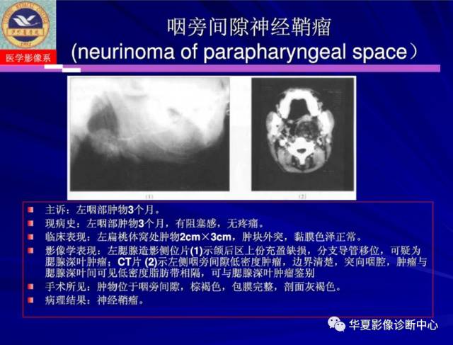 【PPT】涎腺疾病与颞下颌关节疾病影像诊断