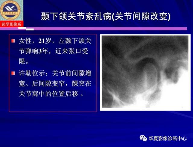 【PPT】涎腺疾病与颞下颌关节疾病影像诊断