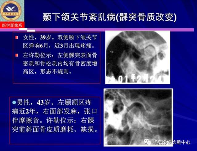【PPT】涎腺疾病与颞下颌关节疾病影像诊断