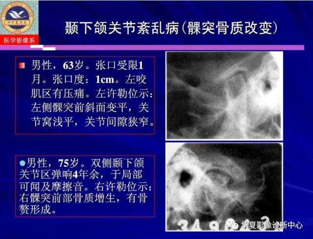 【PPT】涎腺疾病与颞下颌关节疾病影像诊断
