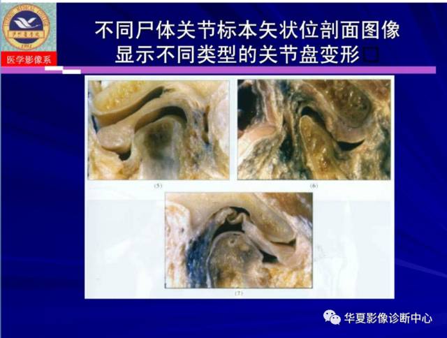 【PPT】涎腺疾病与颞下颌关节疾病影像诊断