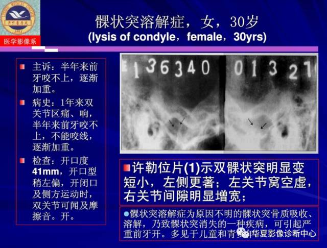 【PPT】涎腺疾病与颞下颌关节疾病影像诊断