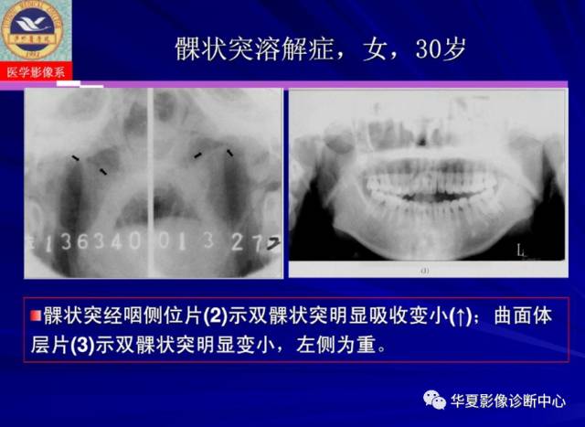 【PPT】涎腺疾病与颞下颌关节疾病影像诊断