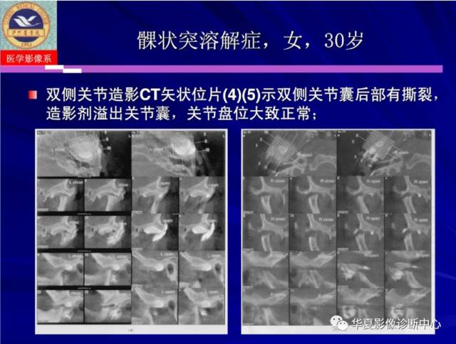 【PPT】涎腺疾病与颞下颌关节疾病影像诊断