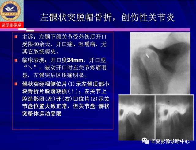 【PPT】涎腺疾病与颞下颌关节疾病影像诊断