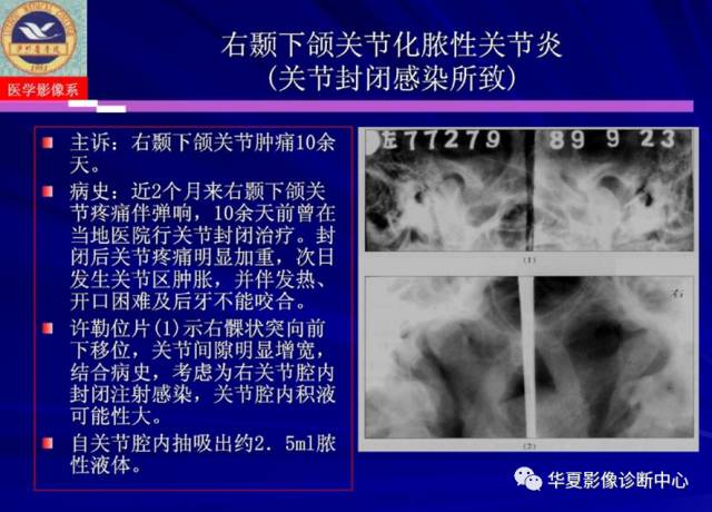 【PPT】涎腺疾病与颞下颌关节疾病影像诊断