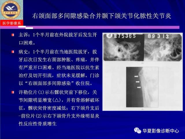 【PPT】涎腺疾病与颞下颌关节疾病影像诊断