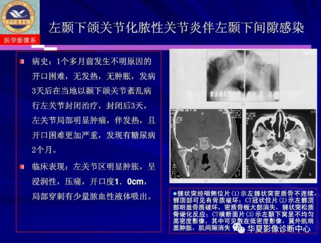 【PPT】涎腺疾病与颞下颌关节疾病影像诊断