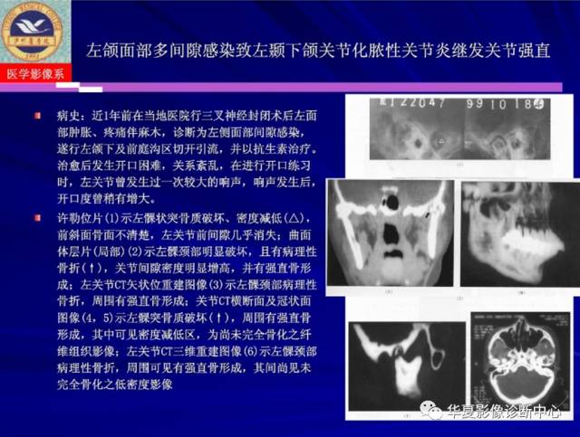 【PPT】涎腺疾病与颞下颌关节疾病影像诊断