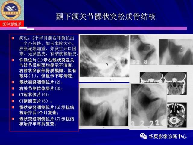 【PPT】涎腺疾病与颞下颌关节疾病影像诊断