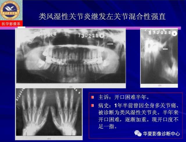 【PPT】涎腺疾病与颞下颌关节疾病影像诊断