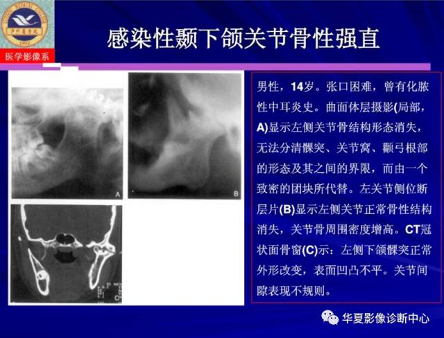 【PPT】涎腺疾病与颞下颌关节疾病影像诊断