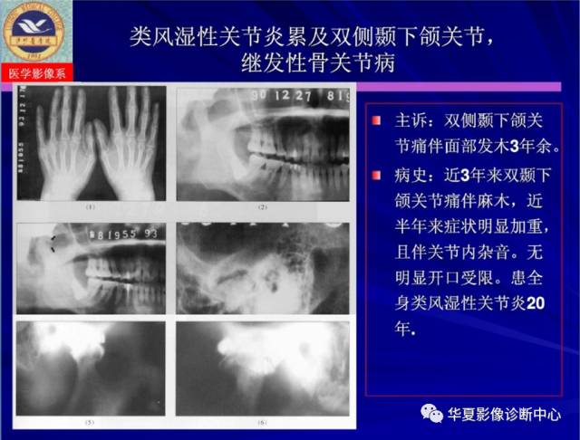 【PPT】涎腺疾病与颞下颌关节疾病影像诊断
