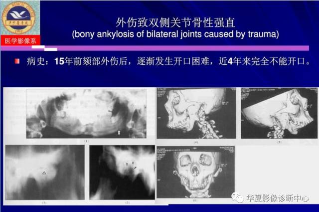 【PPT】涎腺疾病与颞下颌关节疾病影像诊断