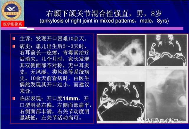 【PPT】涎腺疾病与颞下颌关节疾病影像诊断