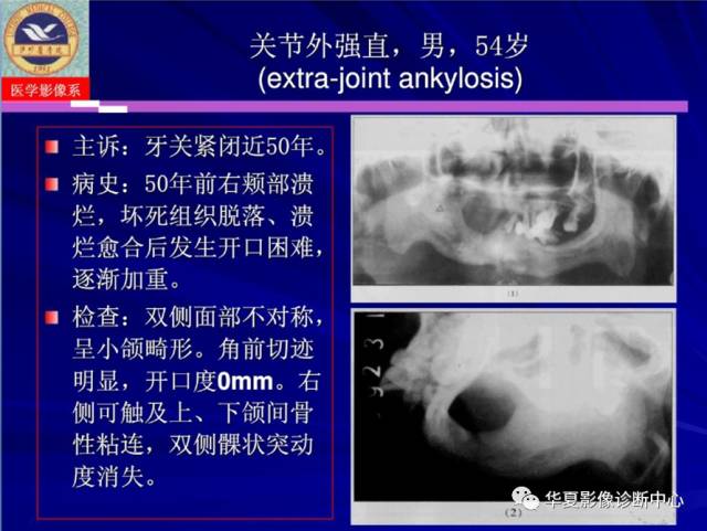【PPT】涎腺疾病与颞下颌关节疾病影像诊断