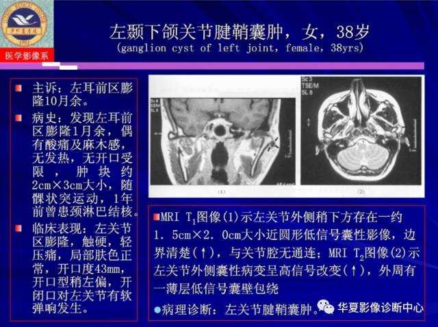 【PPT】涎腺疾病与颞下颌关节疾病影像诊断