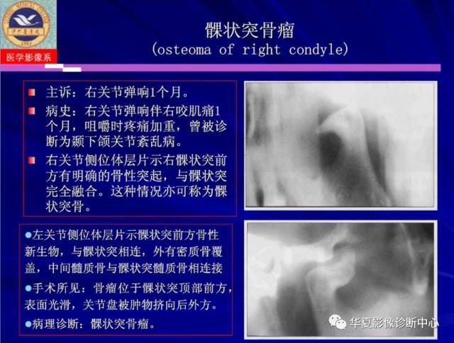 【PPT】涎腺疾病与颞下颌关节疾病影像诊断