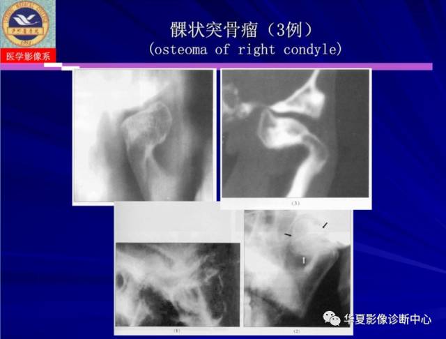【PPT】涎腺疾病与颞下颌关节疾病影像诊断