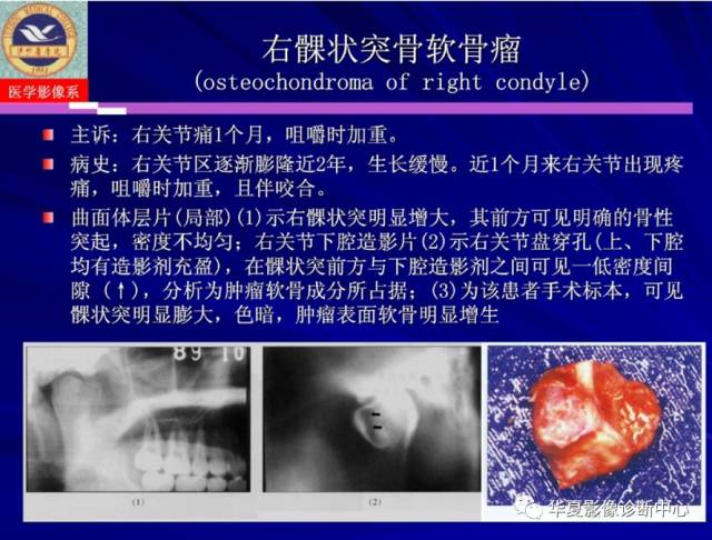 【PPT】涎腺疾病与颞下颌关节疾病影像诊断