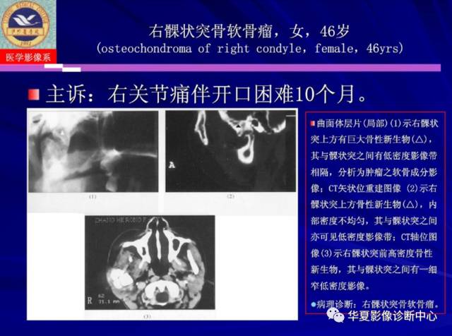 【PPT】涎腺疾病与颞下颌关节疾病影像诊断