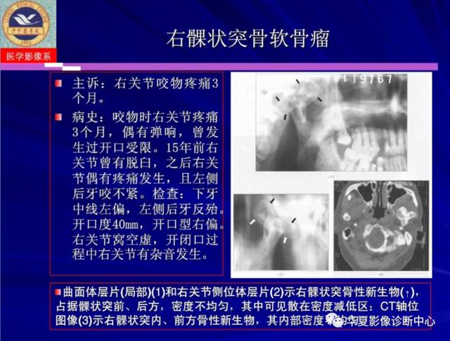 【PPT】涎腺疾病与颞下颌关节疾病影像诊断