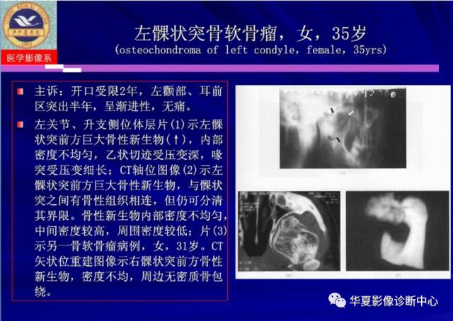 【PPT】涎腺疾病与颞下颌关节疾病影像诊断