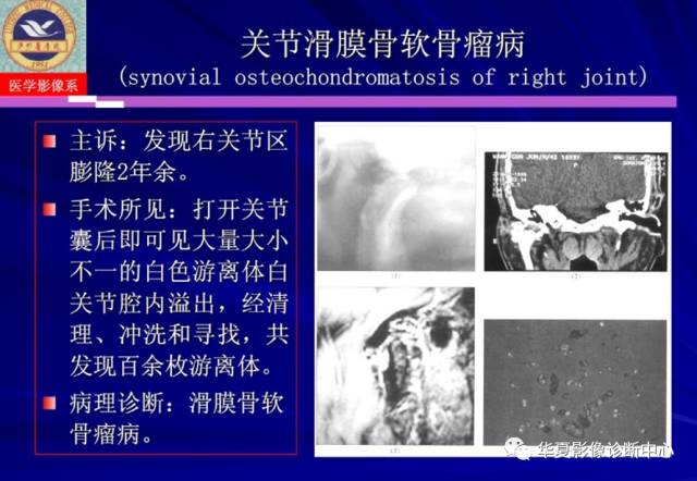 【PPT】涎腺疾病与颞下颌关节疾病影像诊断