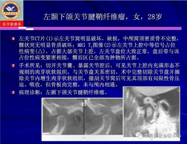 【PPT】涎腺疾病与颞下颌关节疾病影像诊断