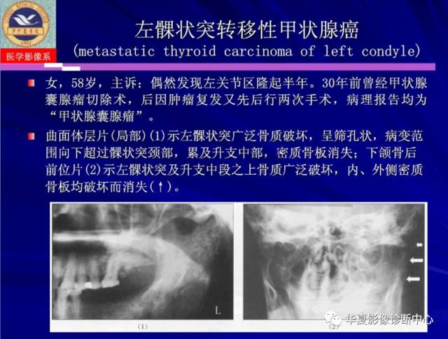 【PPT】涎腺疾病与颞下颌关节疾病影像诊断