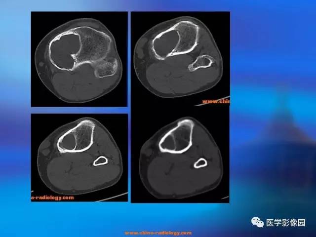 【病例】胫骨良性纤维组织细胞瘤1例X线CT 【病例】胫骨良性纤维组织细胞瘤1例X线CT