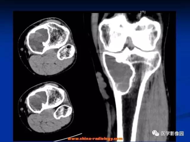 【病例】胫骨良性纤维组织细胞瘤1例X线CT 【病例】胫骨良性纤维组织细胞瘤1例X线CT