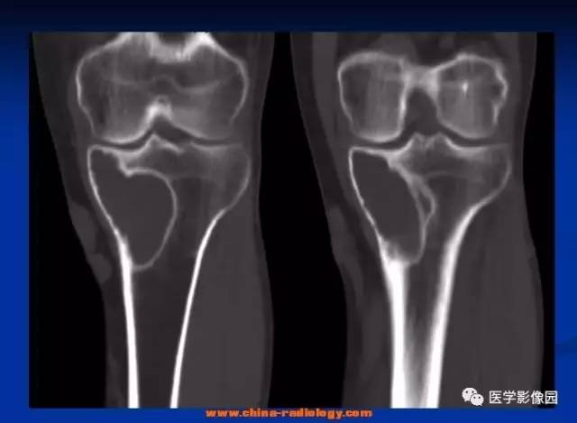 【病例】胫骨良性纤维组织细胞瘤1例X线CT