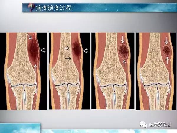 【PPT】骨化性肌炎的影像学诊断