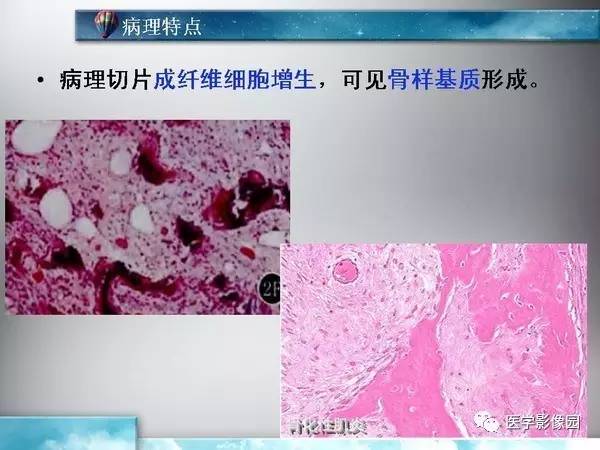 【PPT】骨化性肌炎的影像学诊断