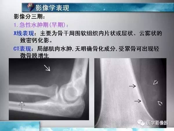 【PPT】骨化性肌炎的影像学诊断