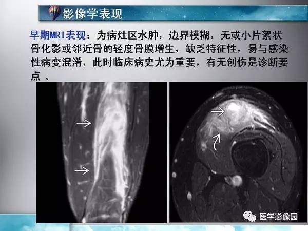 【PPT】骨化性肌炎的影像学诊断