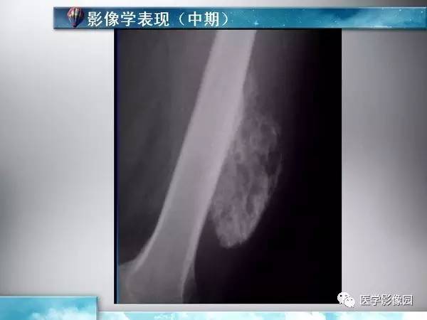 【PPT】骨化性肌炎的影像学诊断