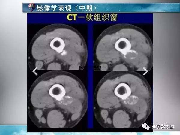 【PPT】骨化性肌炎的影像学诊断